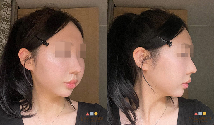 수술 후