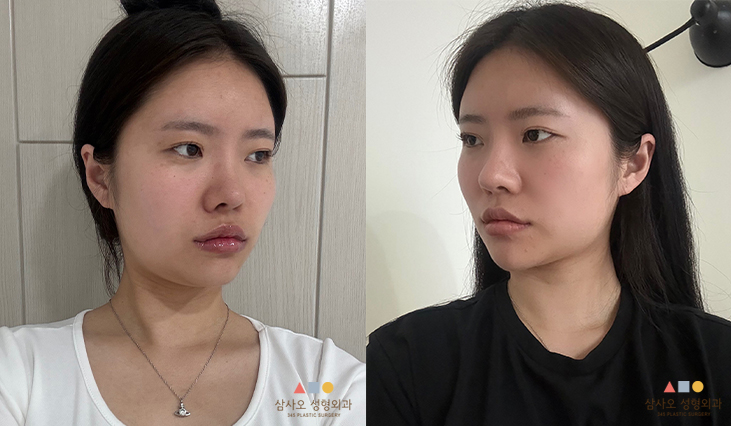 수술 전