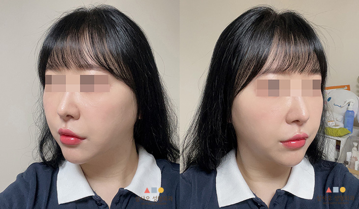 수술 후