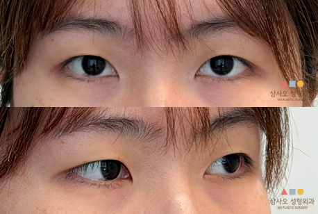 수술 전