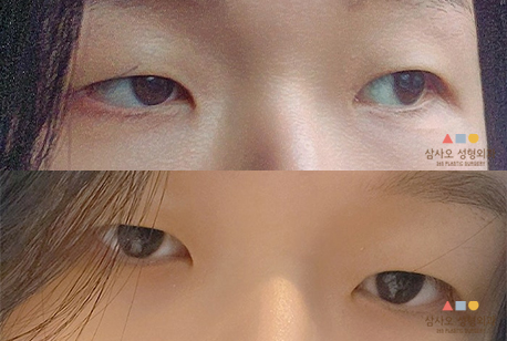 수술 전