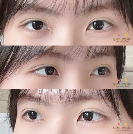 수술 후