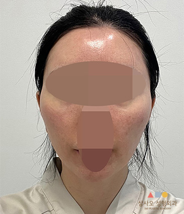 수술 전