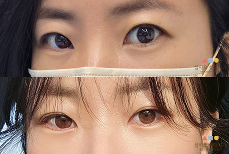 수술 후