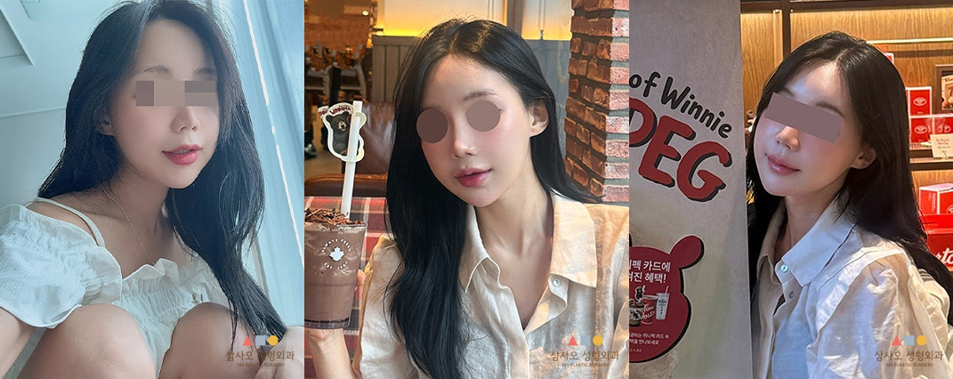 수술 후