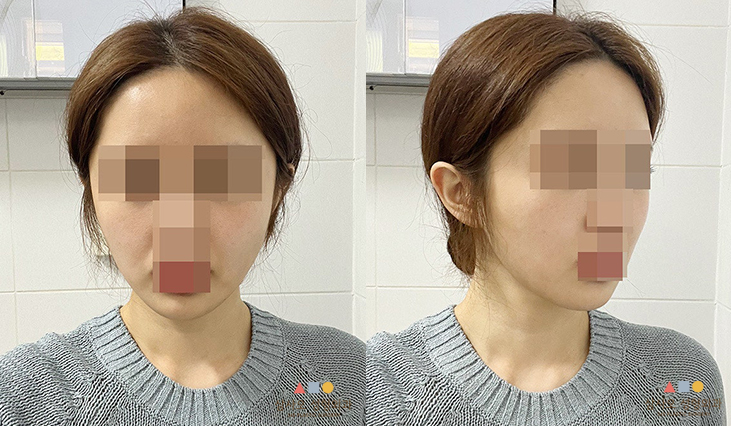 수술 후