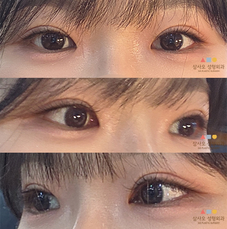 수술 후