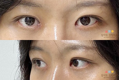 수술 후