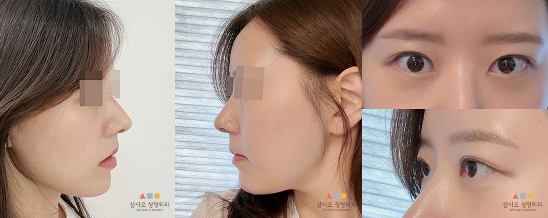 수술 후