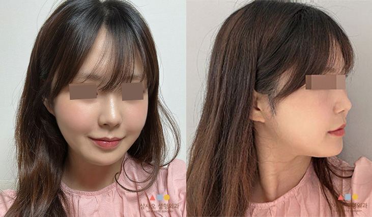 수술 후