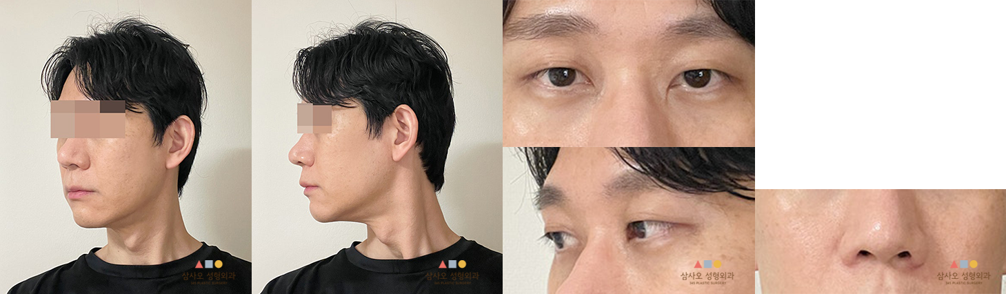 수술 후