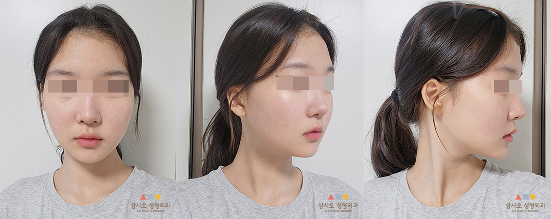수술 후
