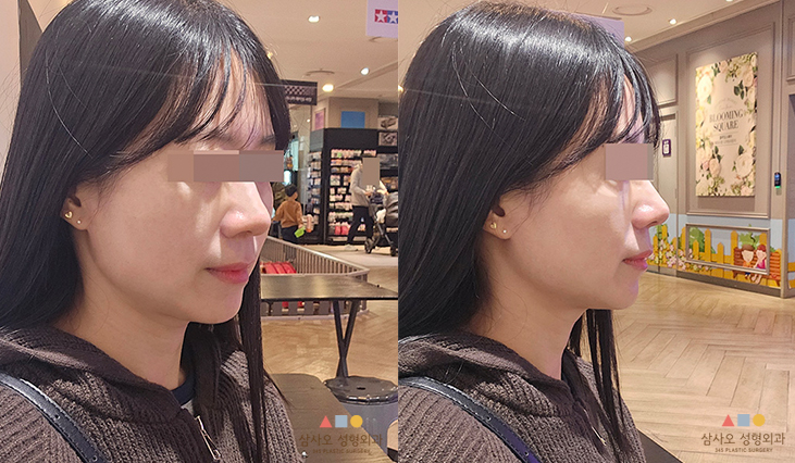 수술 후