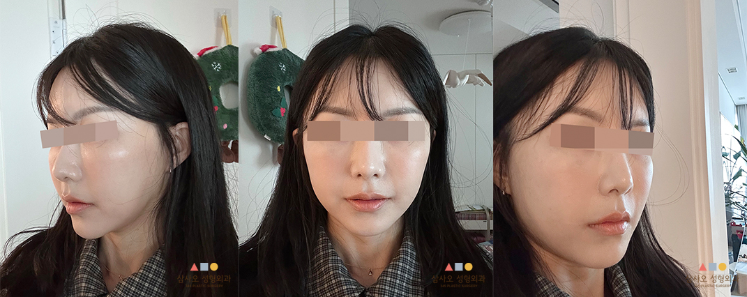 수술 후