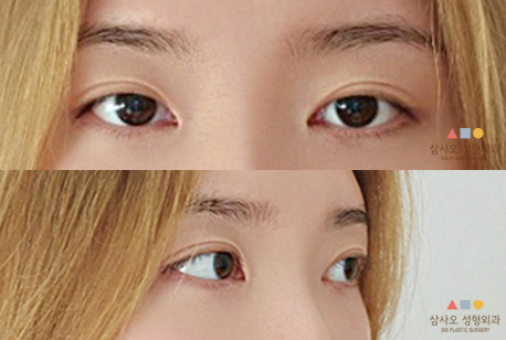 수술 후