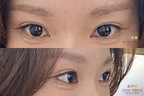 수술 후