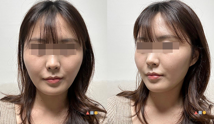 수술 전