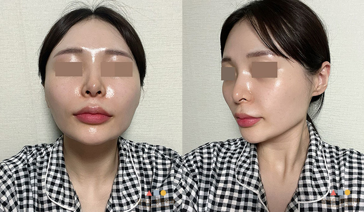 수술 전