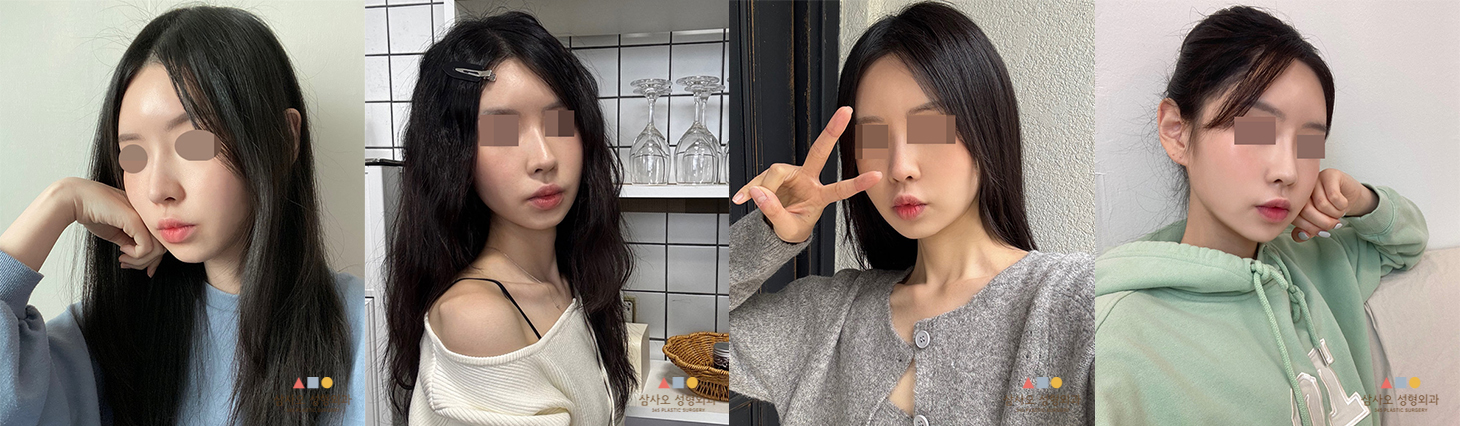 수술 후