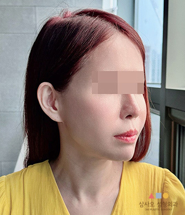 수술 후