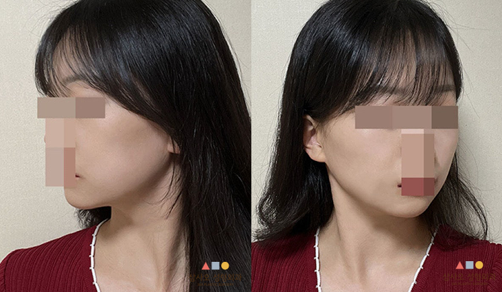 수술 후
