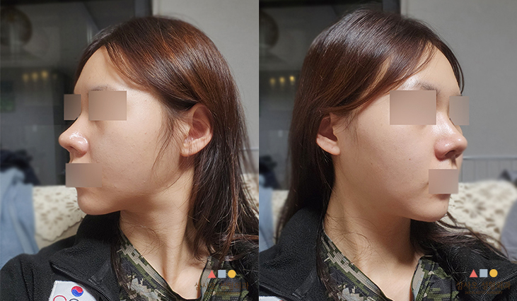 수술 후