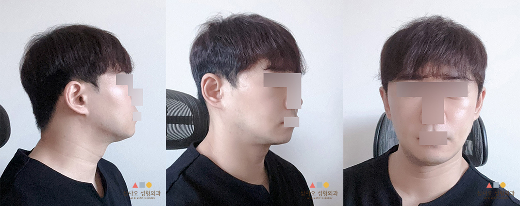 수술 후
