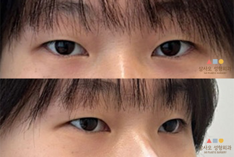 수술 전