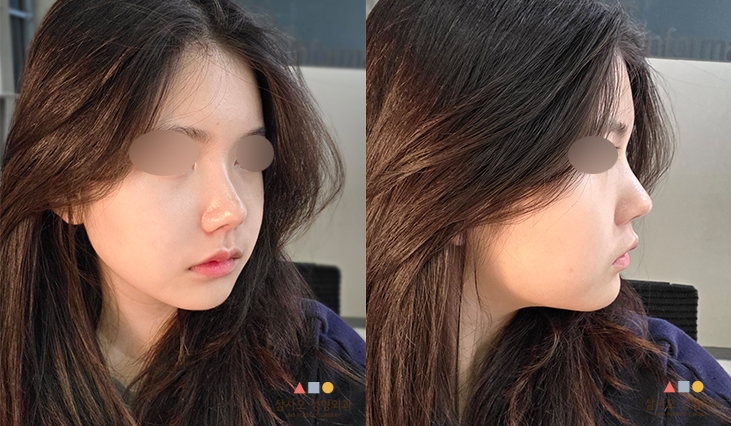 수술 후