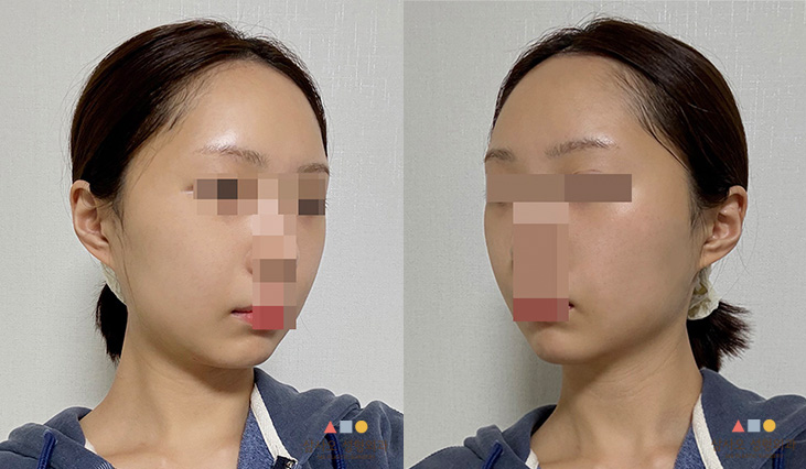 수술 후