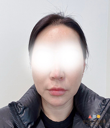수술 전