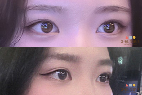 수술 후