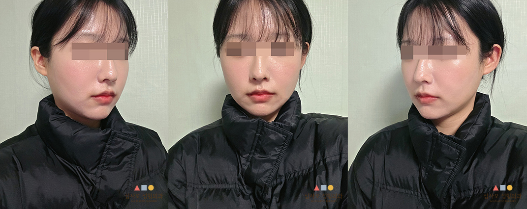 수술 후