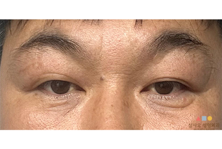 수술 전