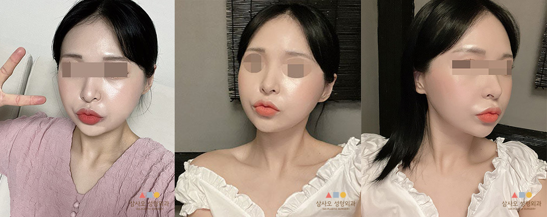 수술 후