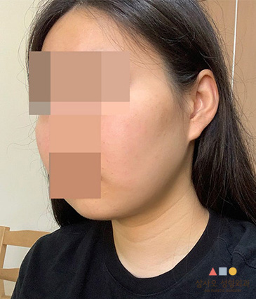 수술 후