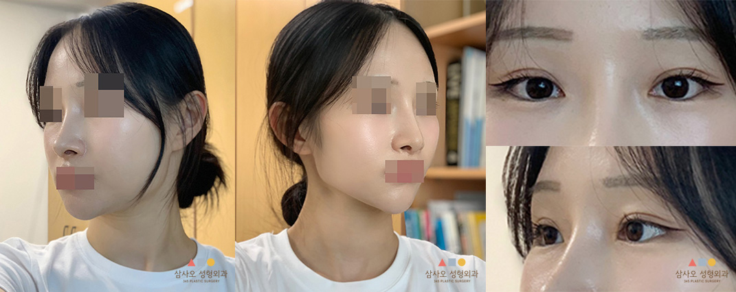 수술 후