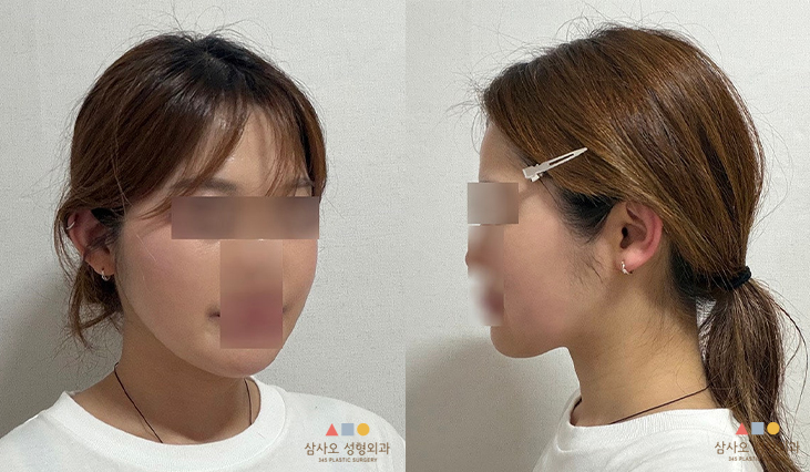 수술 2개월차
