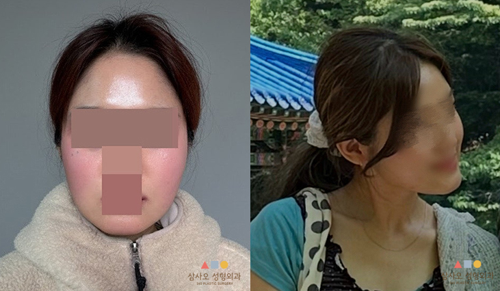 수술 전