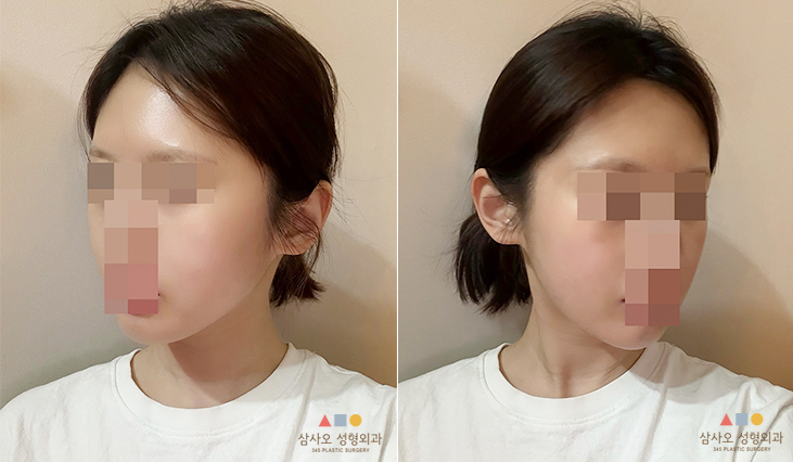 수술 후