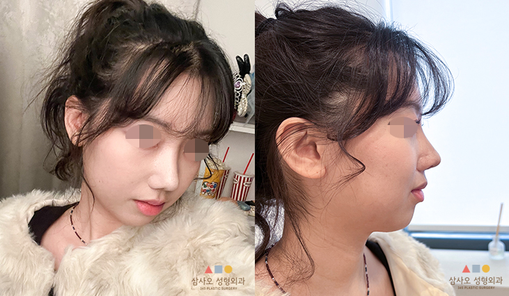 수술 후
