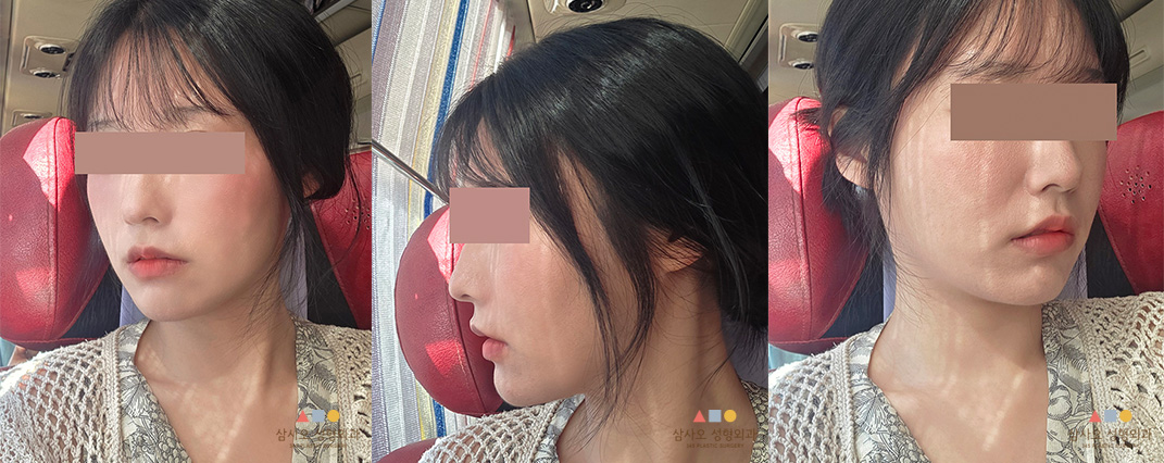 수술 후
