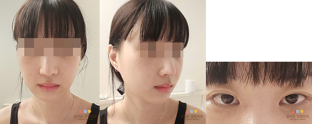 수술 후