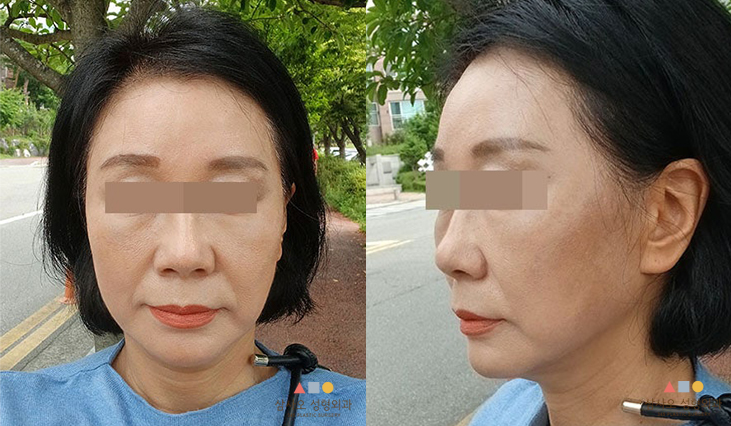 수술 후