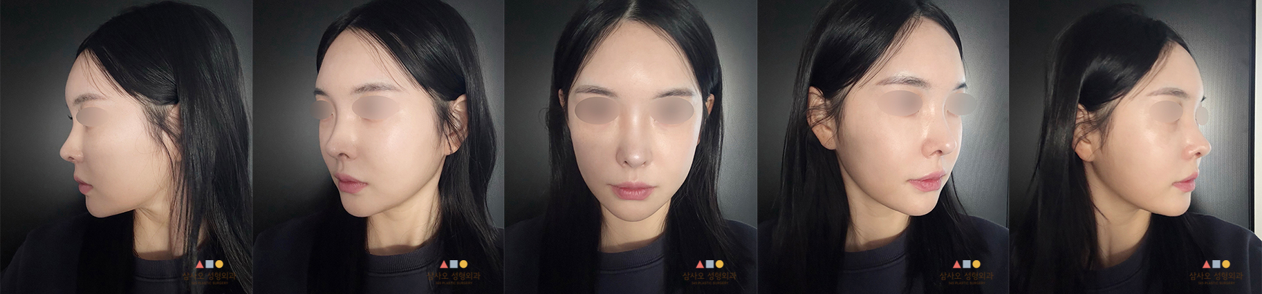 수술 후