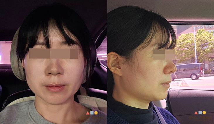 수술 전