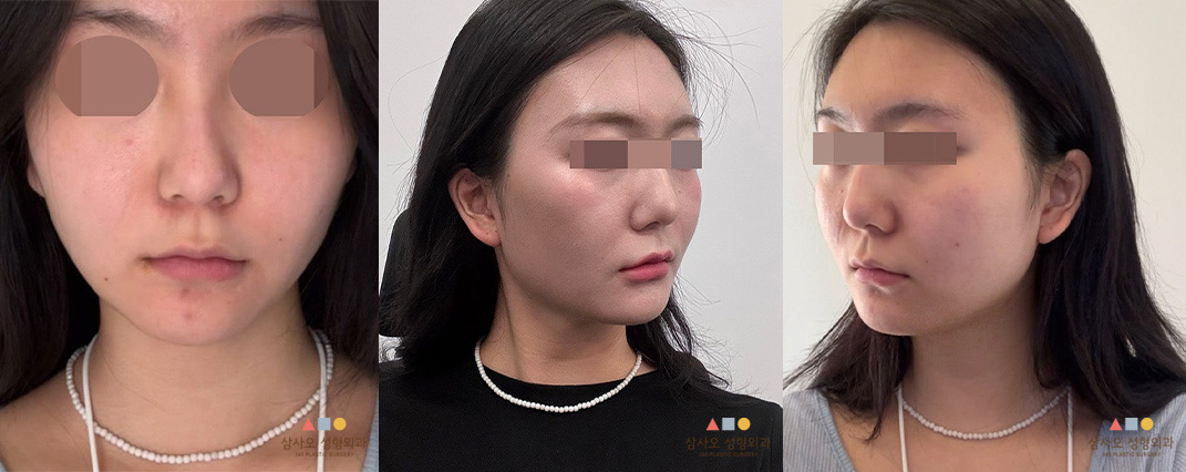 수술 전