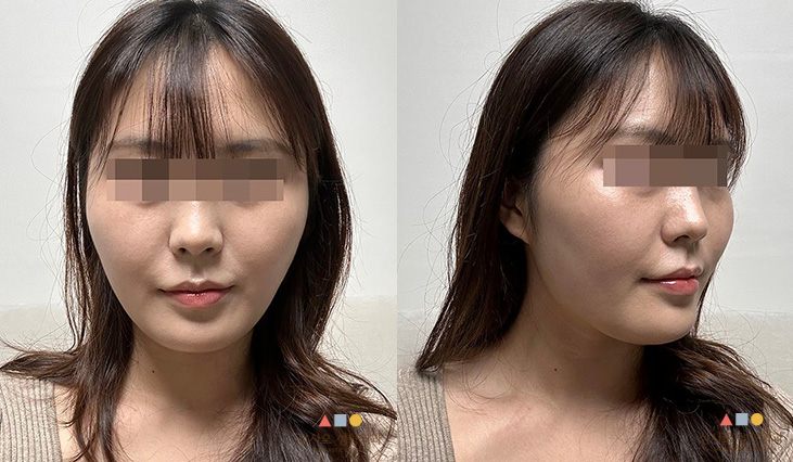 수술 전