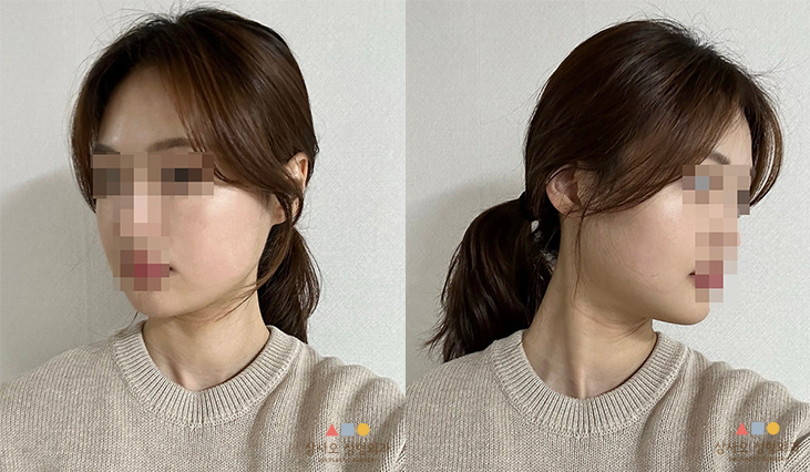 수술 후