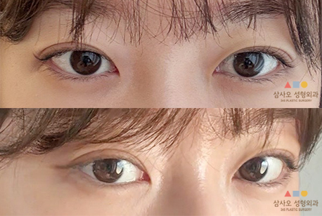수술 후